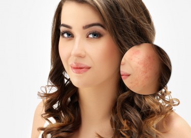 cicatrici da acne, pelle, rimedi naturali