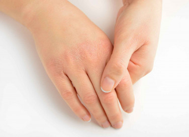 Mani screpolate