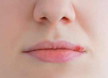 Herpes labiale in gravidanza