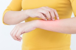 Punture di insetto, come attenuare il prurito con i rimedi naturali della nonna