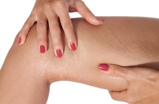 Smagliature interno coscia, perché si formano?