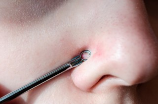 Come schiacciare i punti neri