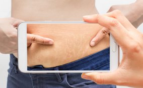 smagliature, pelle smagliata, rimedi naturali