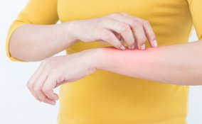 zanzare, punture insetto, rimedi naturali