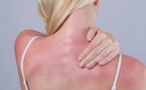 pelle arrossata, bruciature, rimedi veloci