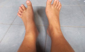 caviglie gonfie cause, caviglie gonfie rimedi, caviglie gonfie