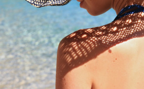 macchie della pelle, melasma, rimedi naturali