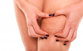 Cellulite