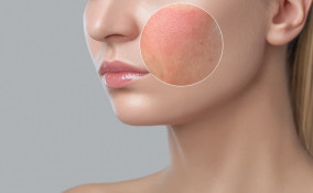 trucco, dermatite, consigli