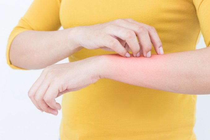 zanzare, punture insetto, rimedi naturali