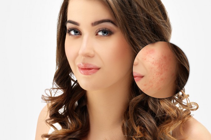 cicatrici da acne, pelle, rimedi naturali