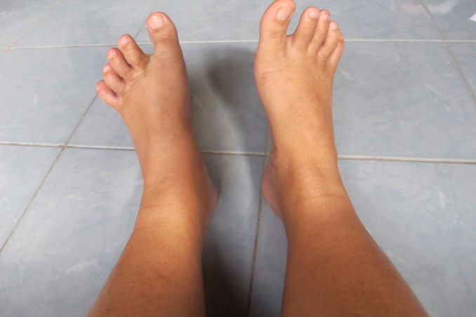 caviglie gonfie cause, caviglie gonfie rimedi, caviglie gonfie