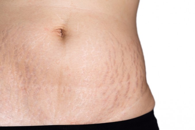 come togliere smagliature rosse, smagliature rosse, smagliature rimedi