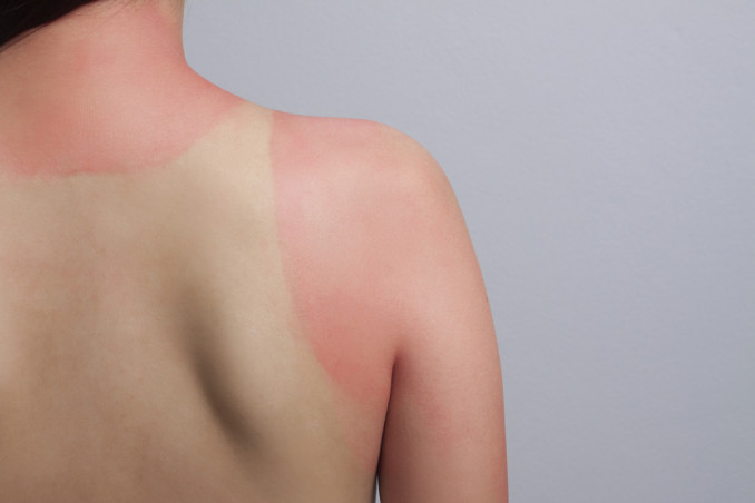 abbronzatura muratore rimedi, abbronzatura muratore