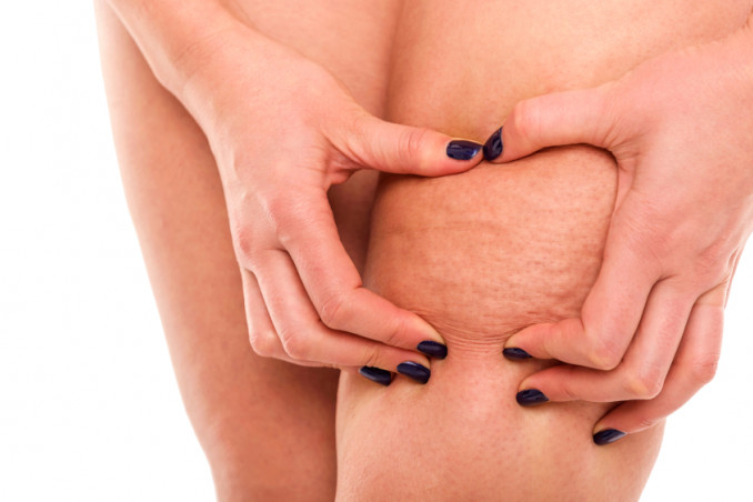 Cellulite